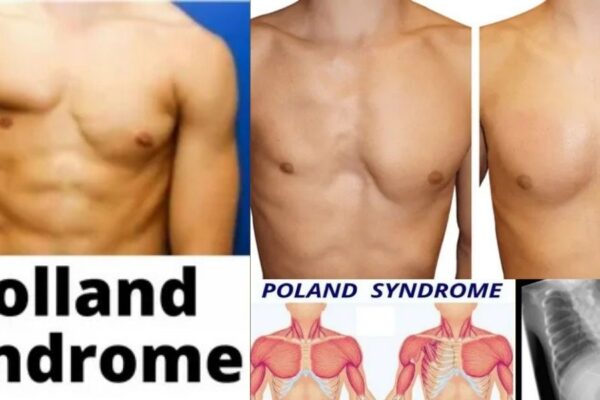 Poland Syndrome