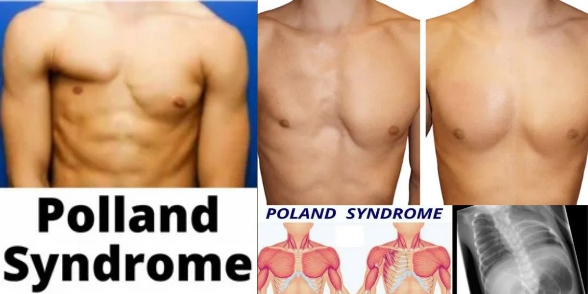 Poland Syndrome